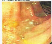 duodenum.jpg